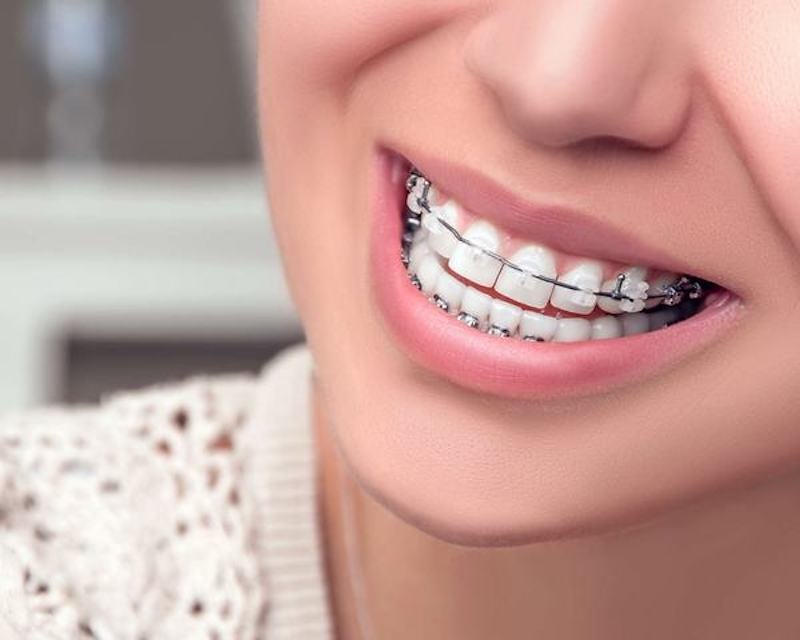 Niềng răng là cách chữa móm nhẹ được áp dụng phổ biến hiện nay