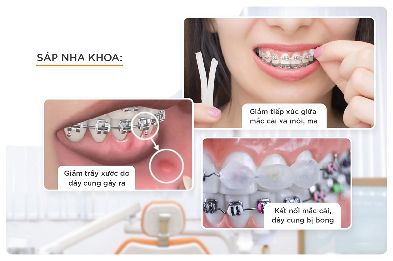 Sáp nha khoa mang lại nhiều lợi ích thiết thực cho người niềng răng