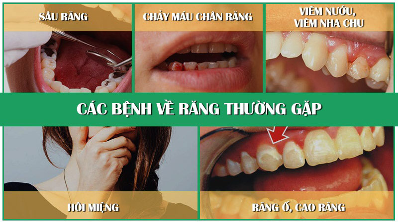 Một số bệnh răng miệng thường gặp