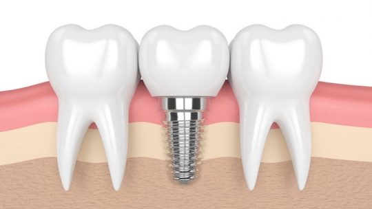 Trồng răng sứ cố định được xem là giải pháp phục hình răng mất tốt nhất hiện nay