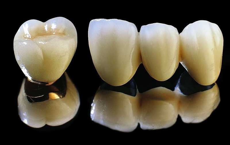 Răng sứ quý kim sử dụng nhiều vật liệu quý hiếm như vàng, bạch kim hay plantin