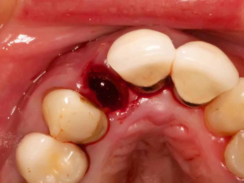 Cục máu đông nếu bị bong ra có sớm sẽ làm tăng nguy cơ viêm xương ổ răng