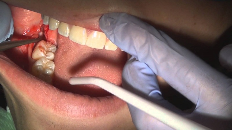 Các biến chứng sau nhổ răng thường do tay nghề bác sĩ kém, vệ sinh không đúng cách