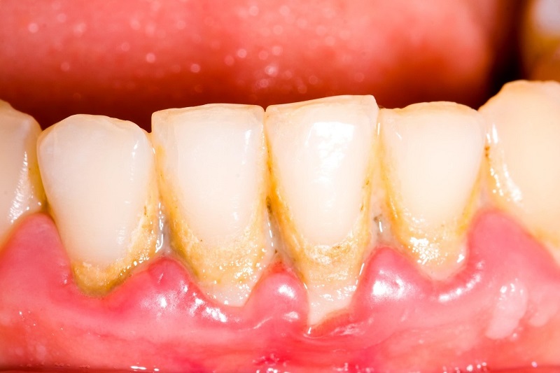 Hình ảnh vôi răng bám trên bề mặt răng lâu ngày mà chưa được xử lý
