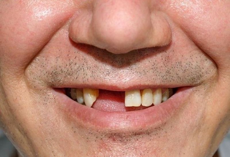 Hiện tượng mất răng nếu ở vị trí răng cửa hay răng nanh sẽ gây mất thẩm mỹ, khiến bạn tự ti