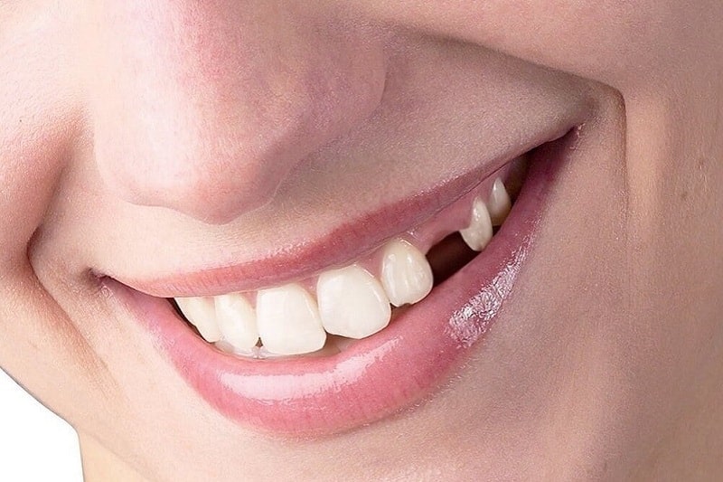 Nhổ răng không trồng lại có sao không hiện vẫn đang là thắc mắc của rất nhiều người