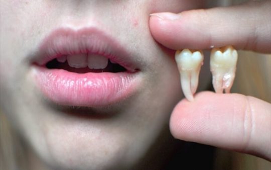 nhổ răng không trồng lại có sao không
