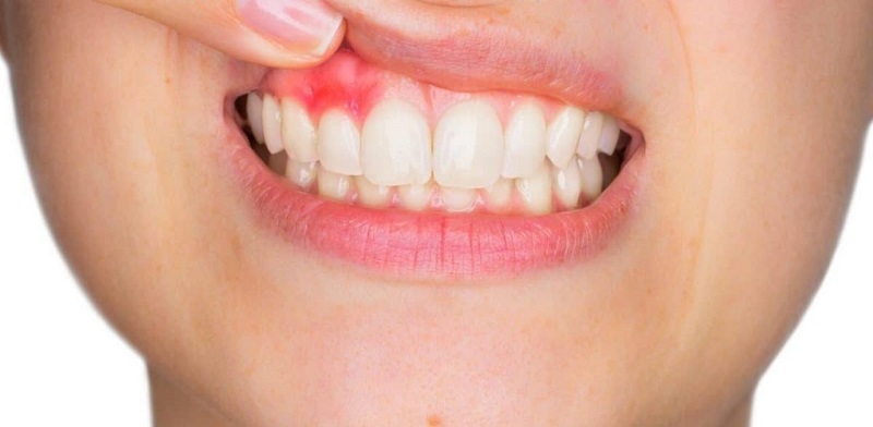 Áp xe chân răng có thể là nguyên nhân khiến lợi bị chảy máu nhiều