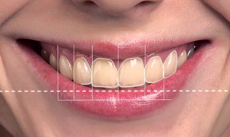 Phần mềm thiết kế nụ cười cho dáng răng như ý