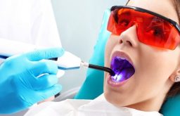phương pháp tẩy trắng răng an toàn