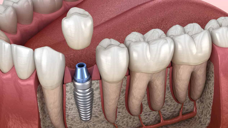 Quy trình trồng răng Implant thường kéo dài từ 1-6 tháng