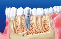 Quy Trình Trồng Răng Implant Chuẩn Đảm Bảo An Toàn, Thẩm Mỹ Nhất