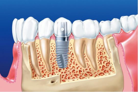 Quy Trình Trồng Răng Implant Chuẩn Đảm Bảo An Toàn, Thẩm Mỹ Nhất