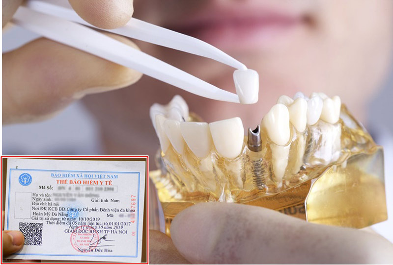 Trồng răng có được hưởng bảo hiểm y tế không? Theo quy định của BHYT thì KHÔNG