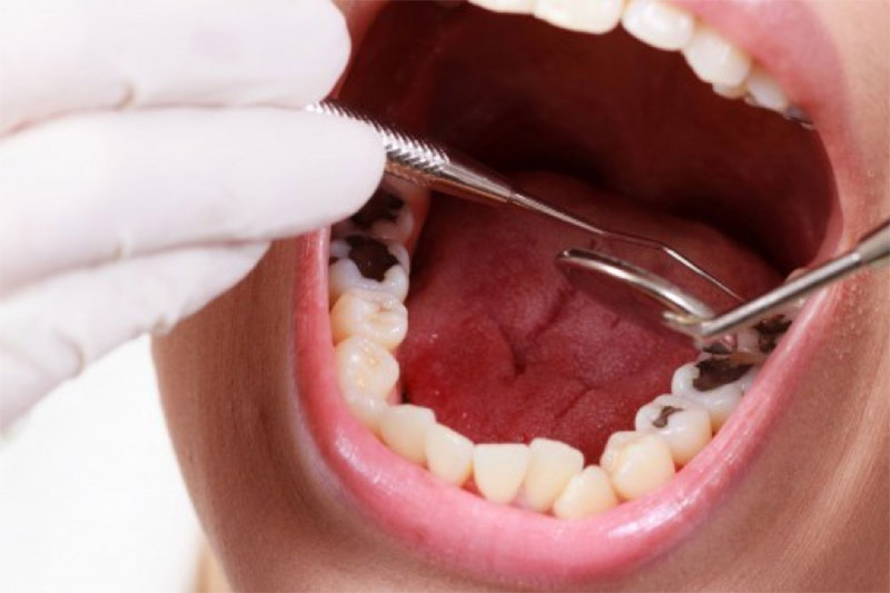 Nếu khám răng, nhổ răng,... vì lý do bệnh lý, bạn sẽ được BHYT hỗ trợ thanh toán