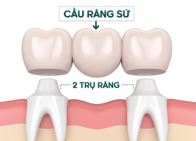 Với kỹ thuật cầu răng sứ, hai răng thật kế cận răng đã mất sẽ được mài nhỏ để làm trụ cho cầu sứ