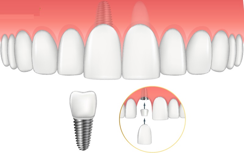 Cắm trụ Implant là bước làm quan trọng nhất trong quy trình cấy ghép Implant