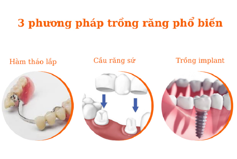 Giá trồng răng cửa phụ thuộc chủ yếu vào phương pháp mà bạn lựa chọn