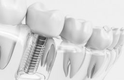 Trồng răng implant có đau không là nỗi lo lắng của rất nhiều người trước khi quyết định thực hiện