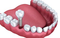 Trồng răng implant có nguy hiểm không là thắc mắc chung của rất nhiều người bệnh