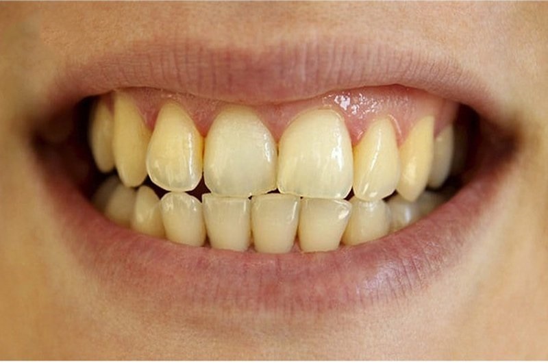 Tại sao tẩy răng không trắng có thể do răng đã nhiễm màu Tetracycline