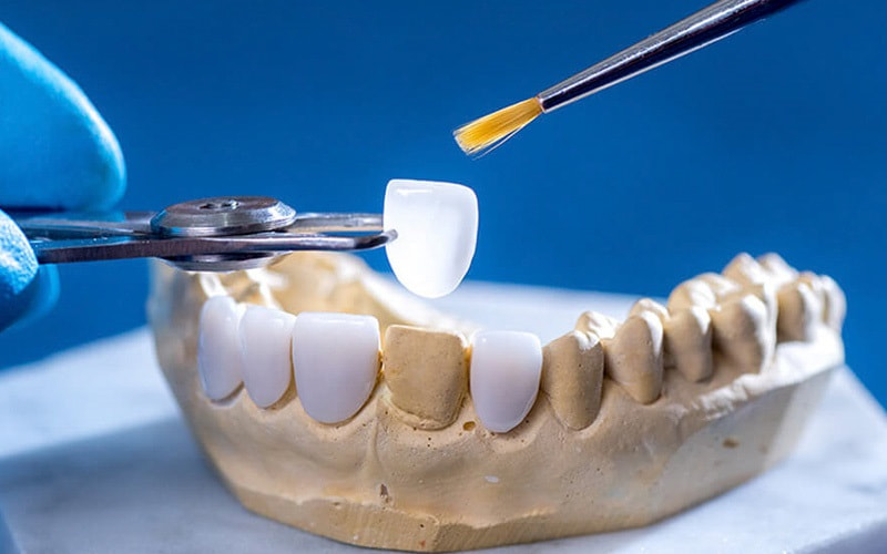 Thực hiện dán sứ Veneer giúp khắc phục tình trạng răng bị xỉn màu, ố vàng
