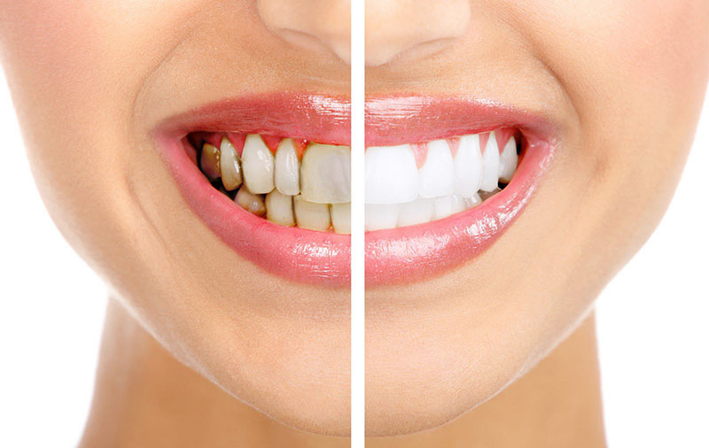 Tẩy trắng răng tại nhà có nhiều ưu điểm, được nhiều người áp dụng
