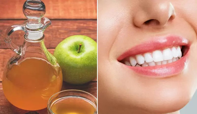 Axit axetic trong giấm táo có thể đánh bật các mảng bám trên răng