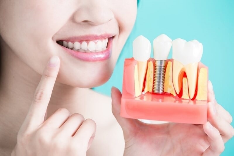 Trồng răng Implant bằng hình thức trả góp giúp bạn nhanh chóng có được nụ cười tự tin