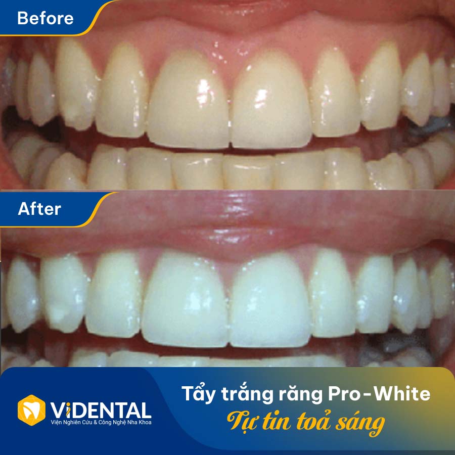 Khách hàng tẩy trắng răng tại Nha khoa Vidental