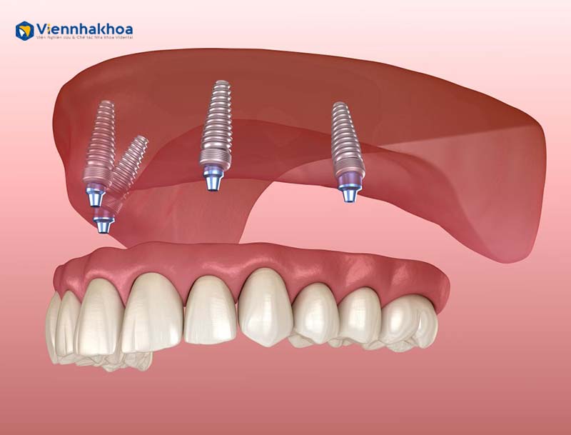 Chi phí trồng răng Implant tại ViDental rất phải chăng, được tối ưu tốt nhất cho người bệnh