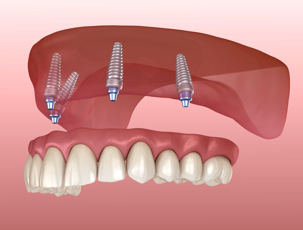 Cấy ghép Implant toàn hàm