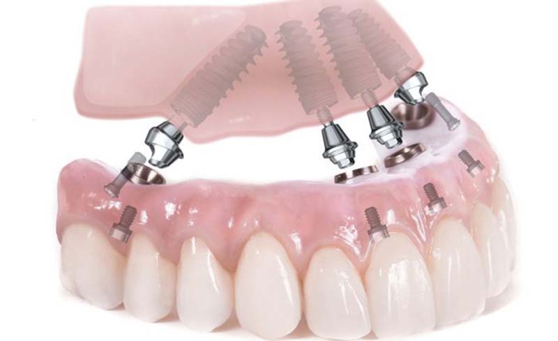 Trồng răng Implant all on 4 được đánh giá cao nhờ phục hồi chức năng ăn nhai, thẩm mỹ