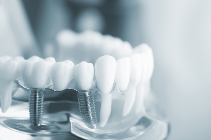 Chất lượng trụ, răng sứ và các vật phẩm y tế quyết định kết quả phục hình răng
