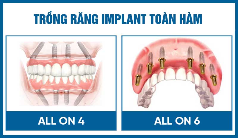 Cấy ghép Implant toàn hàm là kỹ thuật phục hình răng mang tới hiệu quả tốt nhất cho người bệnh