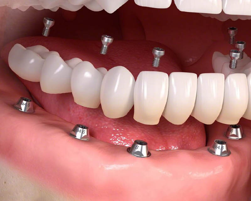 Cấy ghép Implant được nhiều người lựa chọn