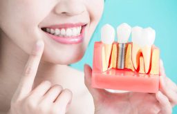 [Giải Đáp] Trồng Răng Implant Có Tốt Không? Lưu Ý Gì Khi Thực Hiện?