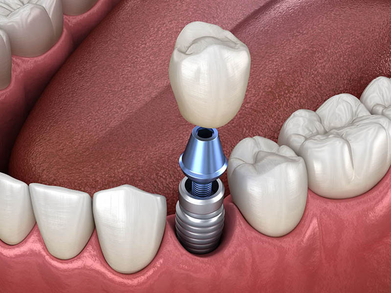 Quy trình trồng implant