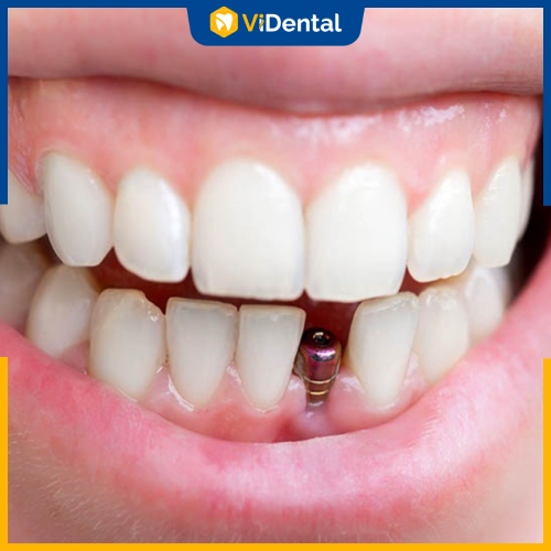 Trồng răng Implant ngay sau nhổ răng để rút ngắn thời gian thực hiện