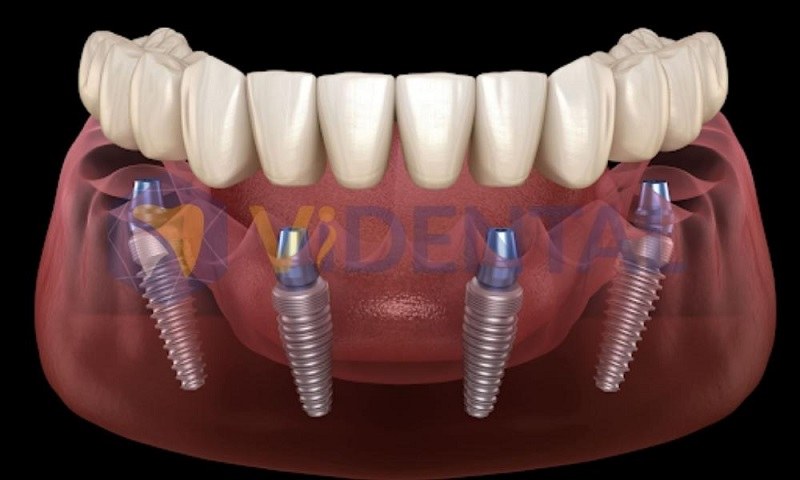 Hình ảnh mô phỏng kỹ thuật trồng răng implant All On 4, vị trí các trụ nằm trên răng số 2 và số 5