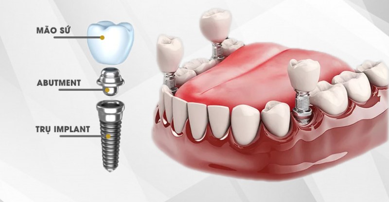 Chi phí trồng răng implant phụ thuộc vào nhiều yếu tố như kỹ thuật, trụ răng, mão sứ
