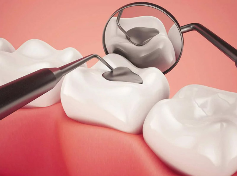 Trám răng được sử dụng khi chân răng còn dài, cùi răng ít tổn thương