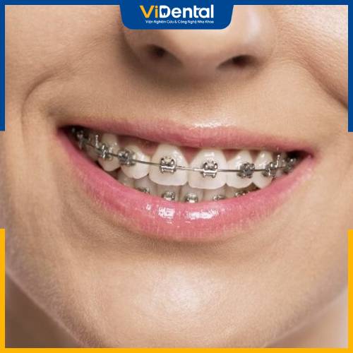 Niềng răng lệch hàm là phương pháp mang lại hiệu quả tối ưu và hạn chế xâm lấn nhất