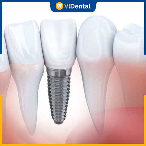 Tuổi thọ răng Implant phụ thuộc vào nhiều yếu tố