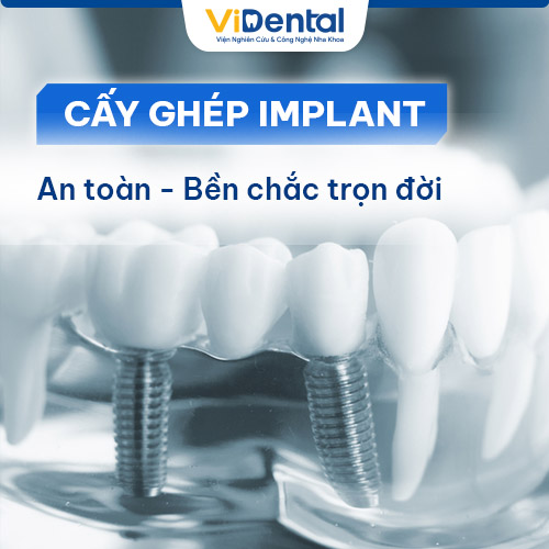 Trồng răng Implant có tốt không? CÓ