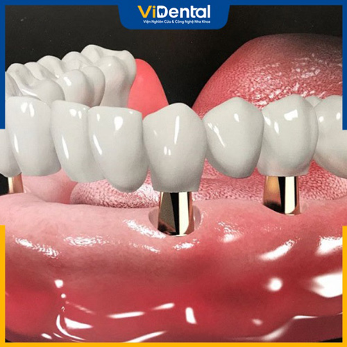 Trồng răng sứ bằng cấy ghép Implant được ưa chuộng nhất