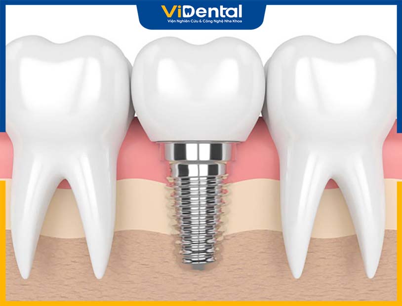 Trụ Implant Titan minh họa