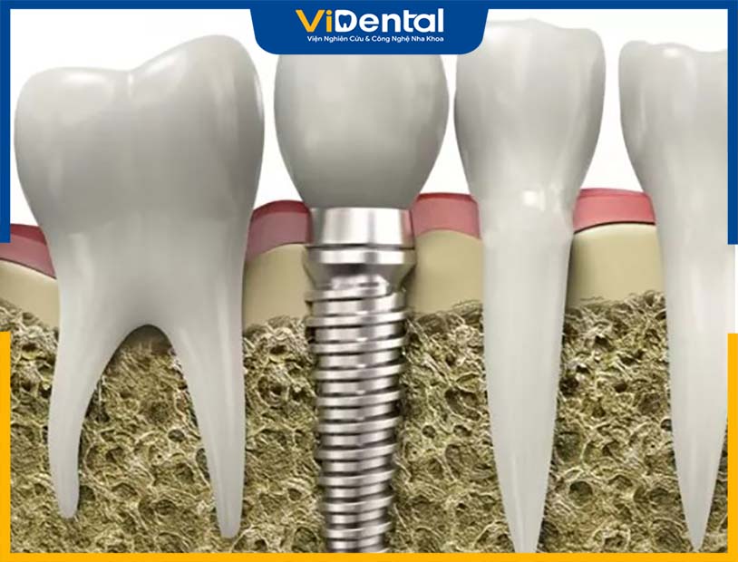 tru-implant-my-thumb