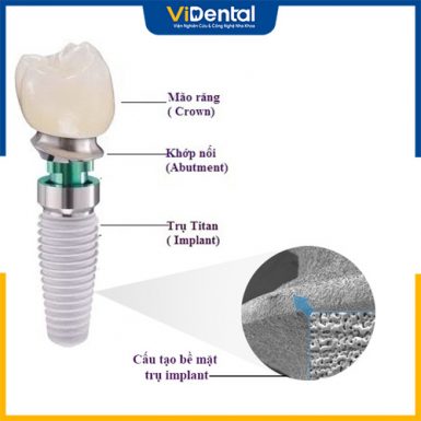 Cấu tạo trụ Implant