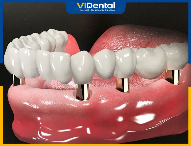 Hình ảnh minh họa quy trình implant